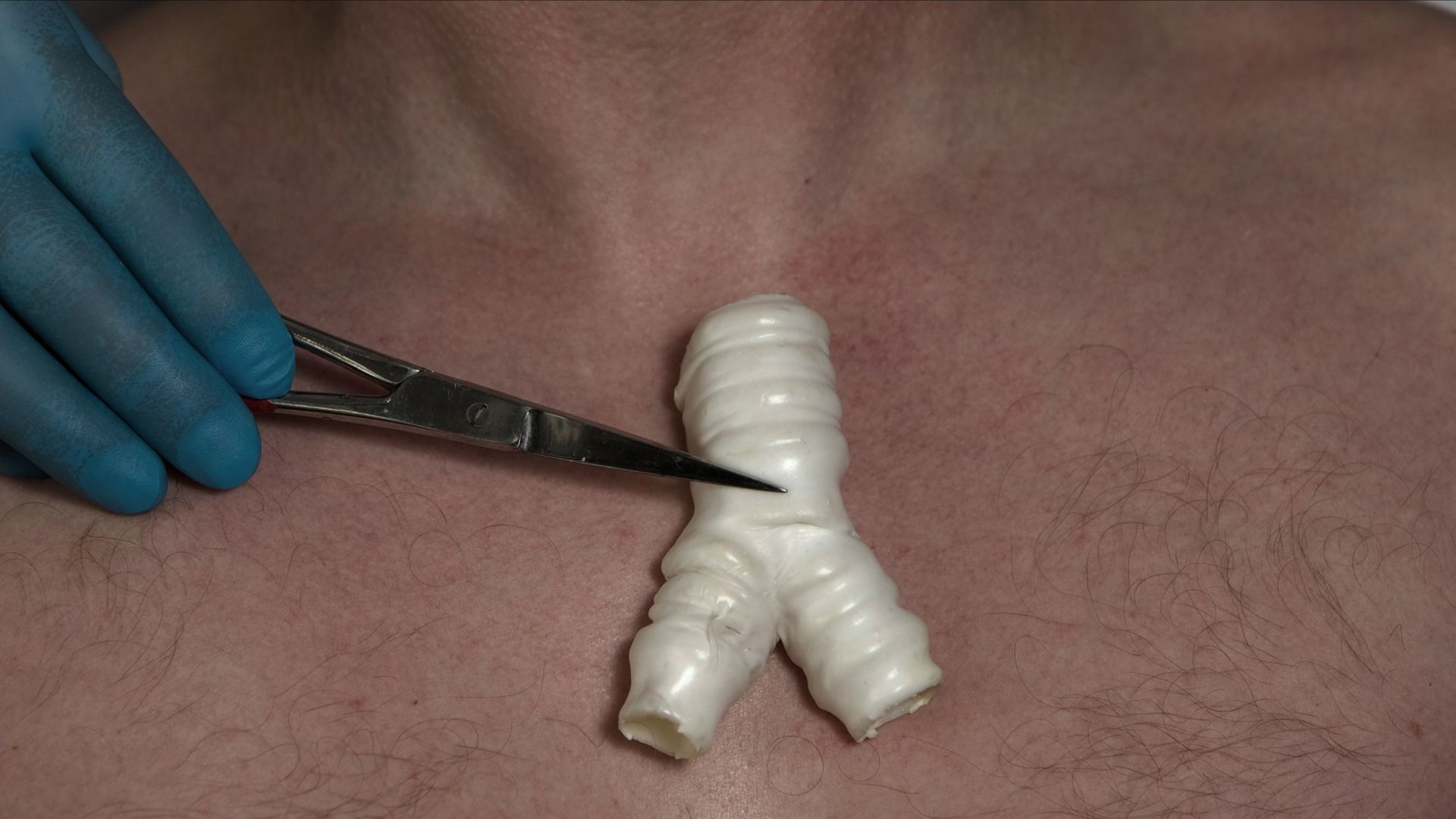 Bad Surgeon, chi è Paolo Macchiarini? La sconvolgente storia vera dietro la serie Netflix 2 bad surgeon paolo macchiarini